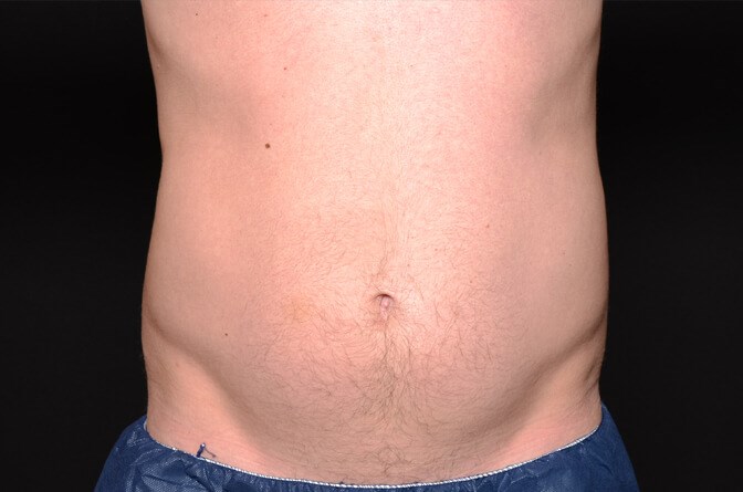 BodyTite Abs Male Before