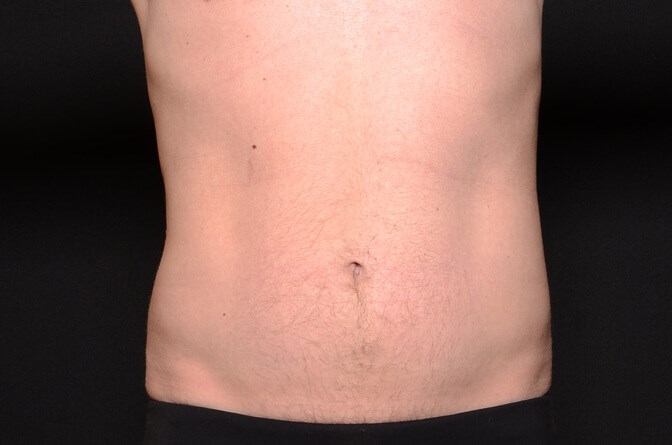 BodyTite Abs Male After