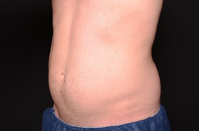 BodyTite Abs Male Before