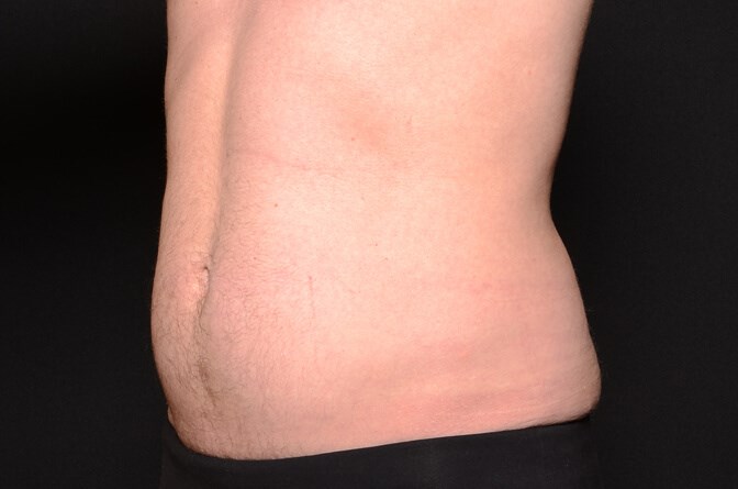 BodyTite Abs Male After