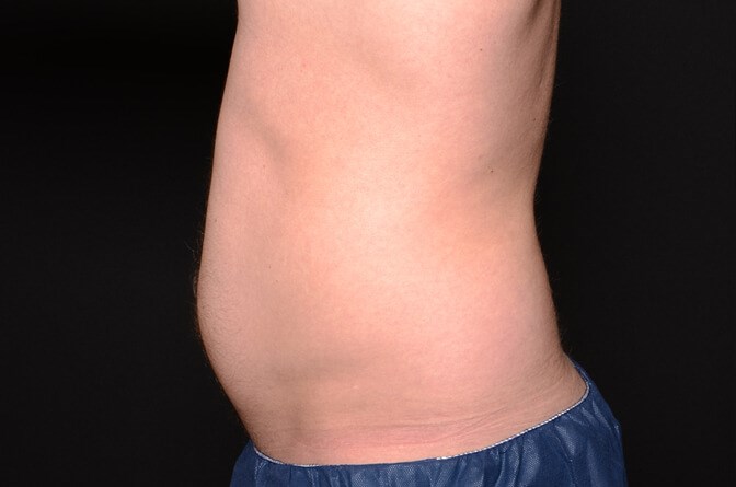 BodyTite Abdomen Before