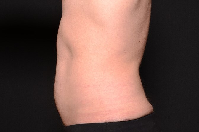 BodyTite Abdomen After