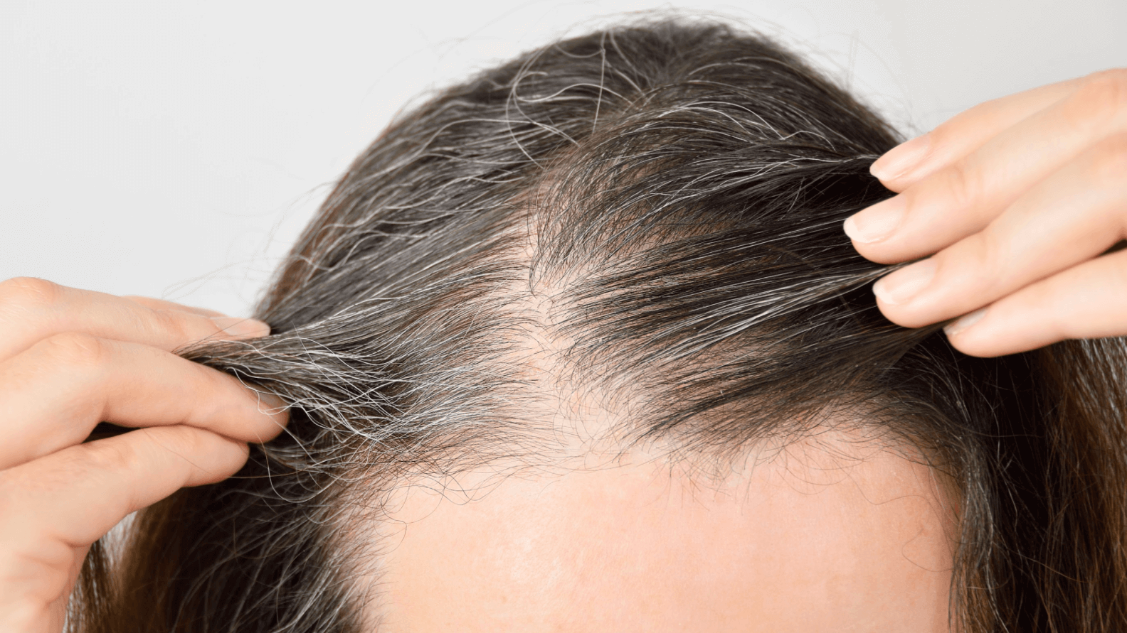 I Am Balding. Is the NeoGraft® Hair Transplant for Me? I Am Balding. Is the NeoGraft® Hair Transplant for Me?