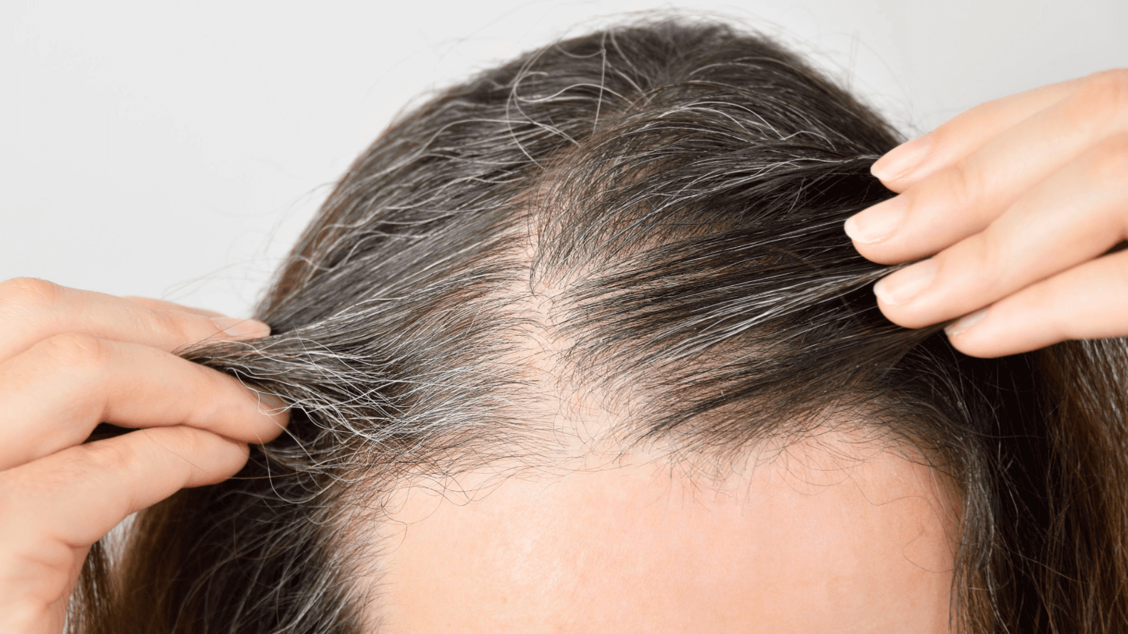 I Am Balding. Is the NeoGraft® Hair Transplant for Me?